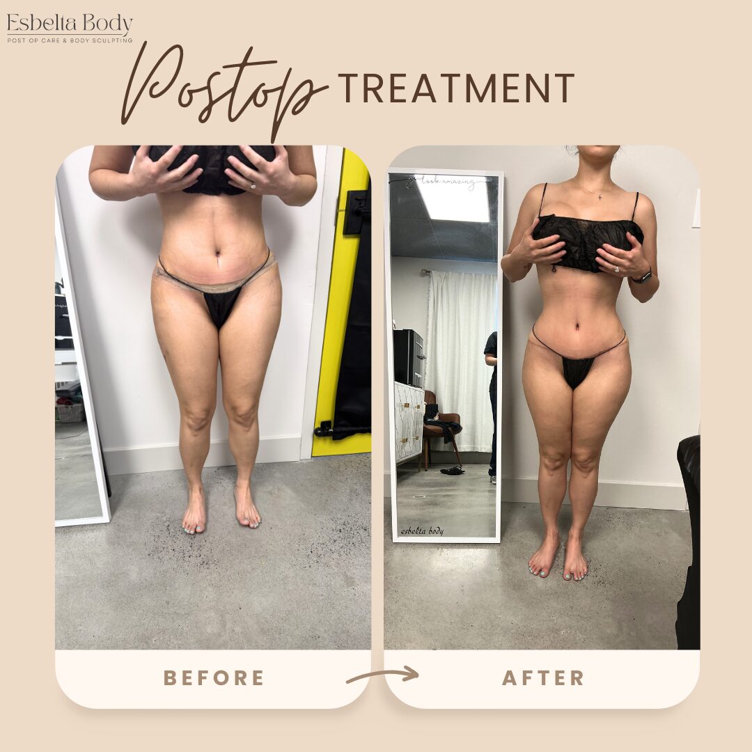 Side-by-side images showing a woman's body before and after treatment, with visible body changes, in a neutral setting.