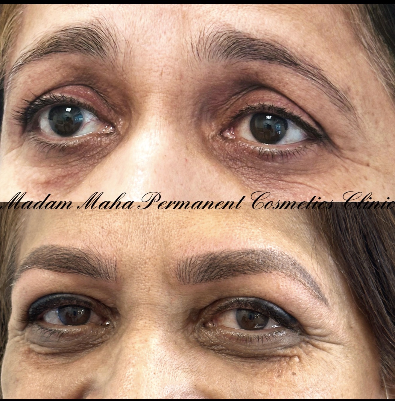 Close-up of eyes before and after cosmetic treatment, showing reduced dark circles and improved skin appearance.